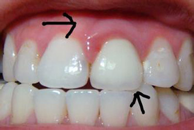牙齿松动怎么办 牙齿松动怎么治疗牙齿松动怎么办 牙齿松动怎么治疗