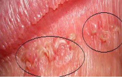 女性湿疣初期症状