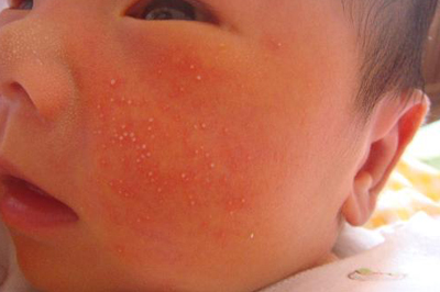 小孩长湿疹是什么原因