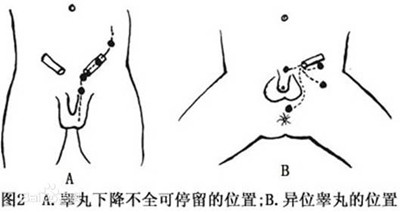 睾丸涨疼痛是怎么回事