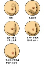 乳腺癌的早期症状图片