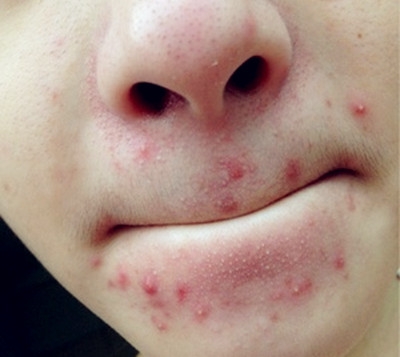 嘴巴周围长痘痘是什么原因