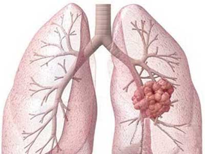 肺癌饮食禁忌