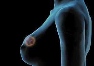 乳腺癌的早期症状图片