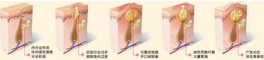 怎么去除脸上的青春痘