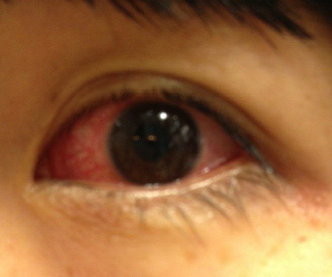 眼睛红血丝是怎么回事