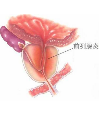 男性得了前列腺炎怎么办