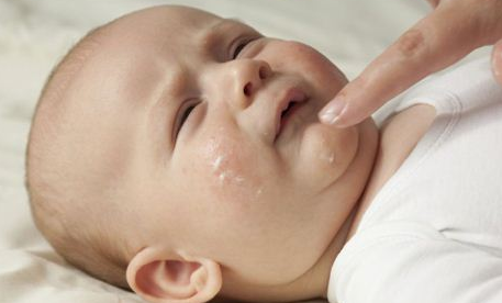 婴儿湿疹吃什么奶粉