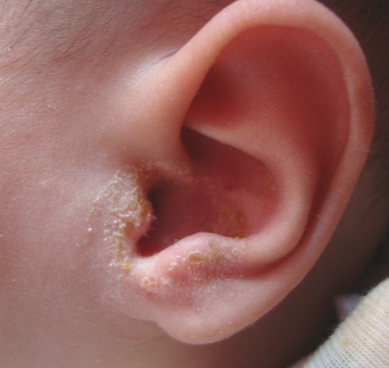 孩子耳朵疼怎么回事