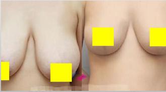 女性胸部下垂的原因