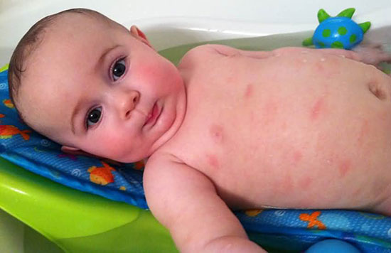 三个月宝宝长湿疹怎么办