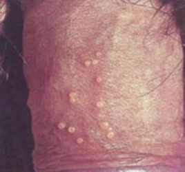 男人生殖器疱疹的表现