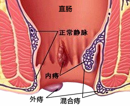 治疗痔疮最有效的方法