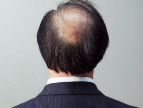 男性掉头发是什么原因引起的