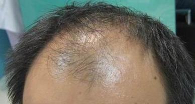 脂溢性脱发的症状表现