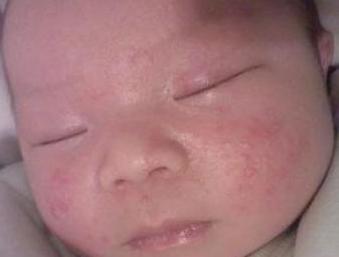 宝宝长湿疹是什么原因呢