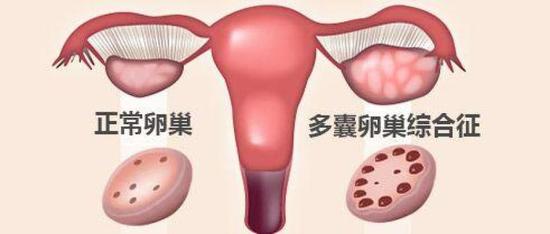 女性多囊卵巢囊肿是怎么回事
