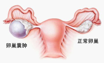 卵巢囊肿如何预防