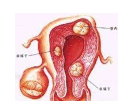 卵巢囊肿怎么引起的