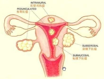子宫小肌瘤怎么形成的
