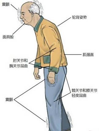 老年人患帕金森的症状有哪些