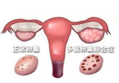 多囊性卵巢综合症的症状