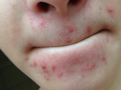 嘴唇周围长痘痘是什么原因