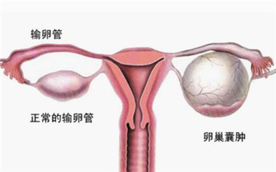 卵巢囊肿会有什么影响