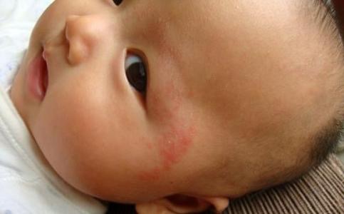 宝宝脸上湿疹怎么护理