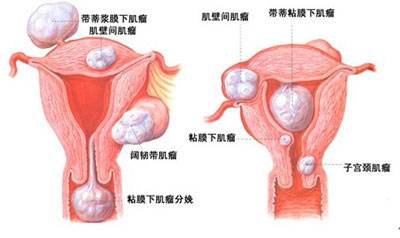 子宫肌瘤有什么症状