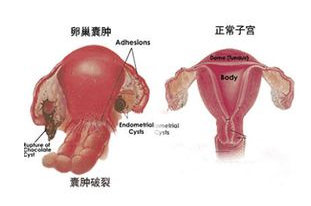 多囊卵巢综合症表现有哪些