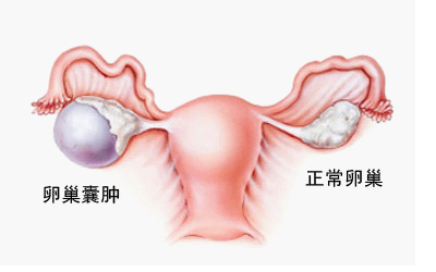 卵巢囊肿是怎样形成的