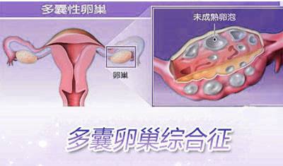 多囊卵巢综合症表现有哪些