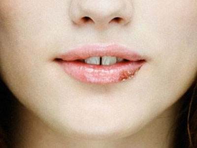 嘴唇起泡是什么原因
