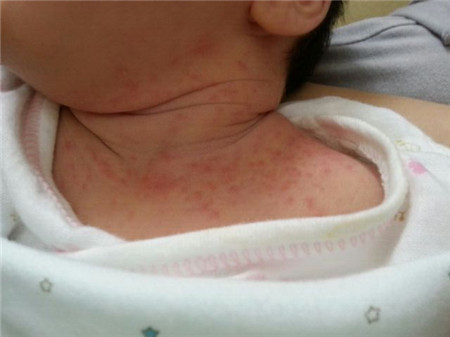 新生儿满脸湿疹怎么办呢