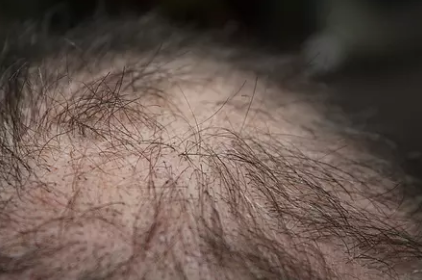 男性局部脱发是什么原因