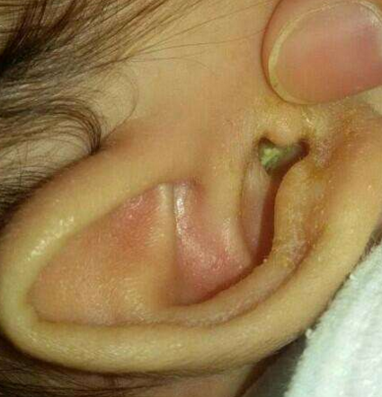 关于小儿中耳炎的治疗方法