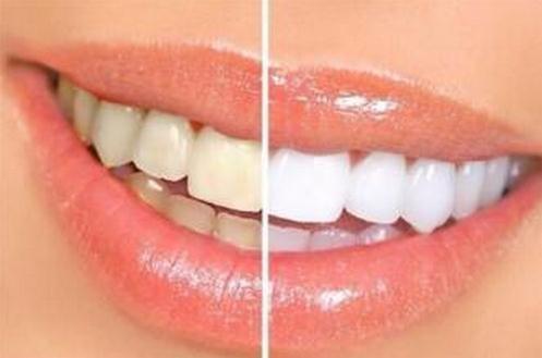 牙齿发黄怎么办？这几个方法告诉你！